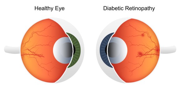 Illustration of hemorrhage in retina - Diabetic Retinopathy