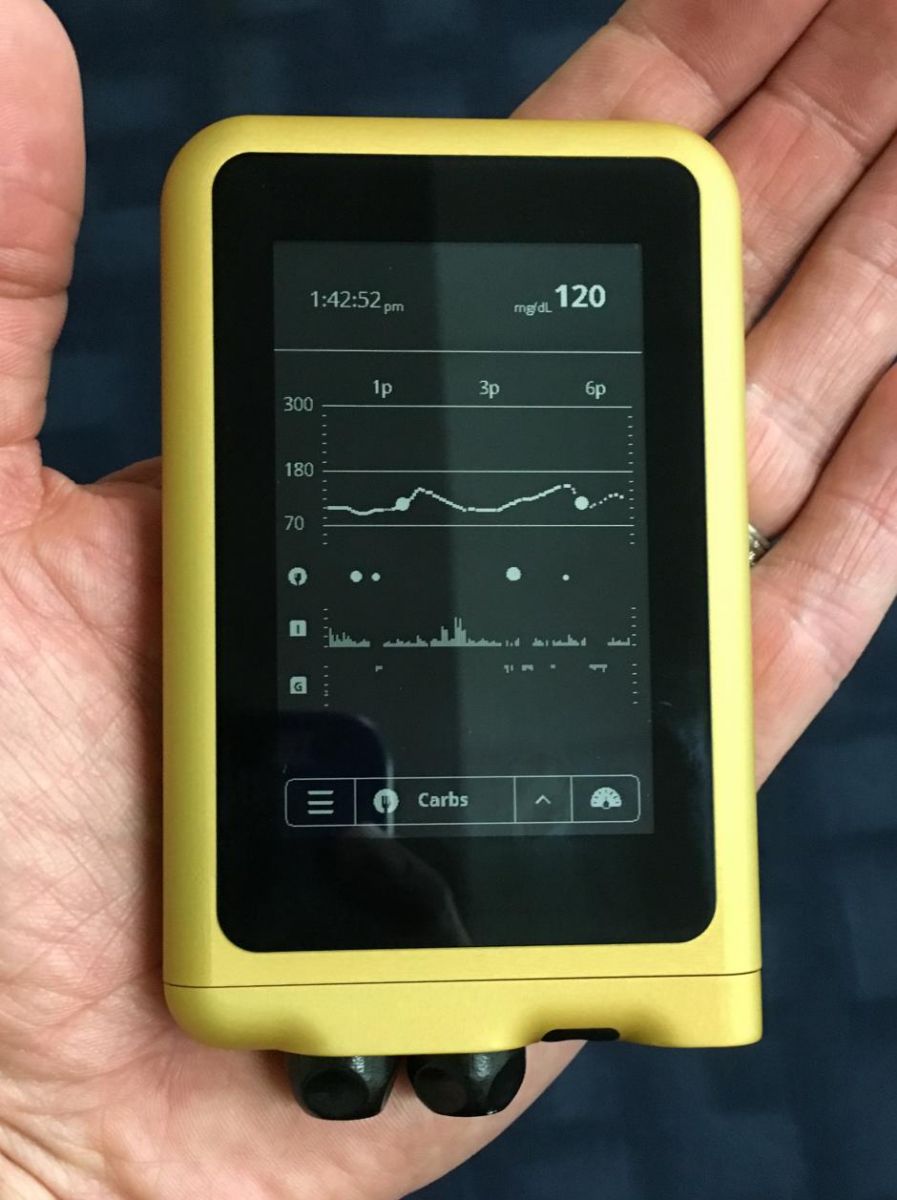 The iLet (Bionic Pancreas) – SUGAR HIGH SUGAR LOW – TYPE 1 D LIFE